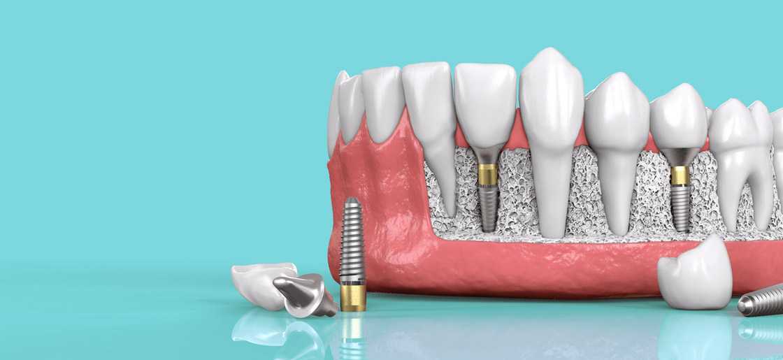 dental implants