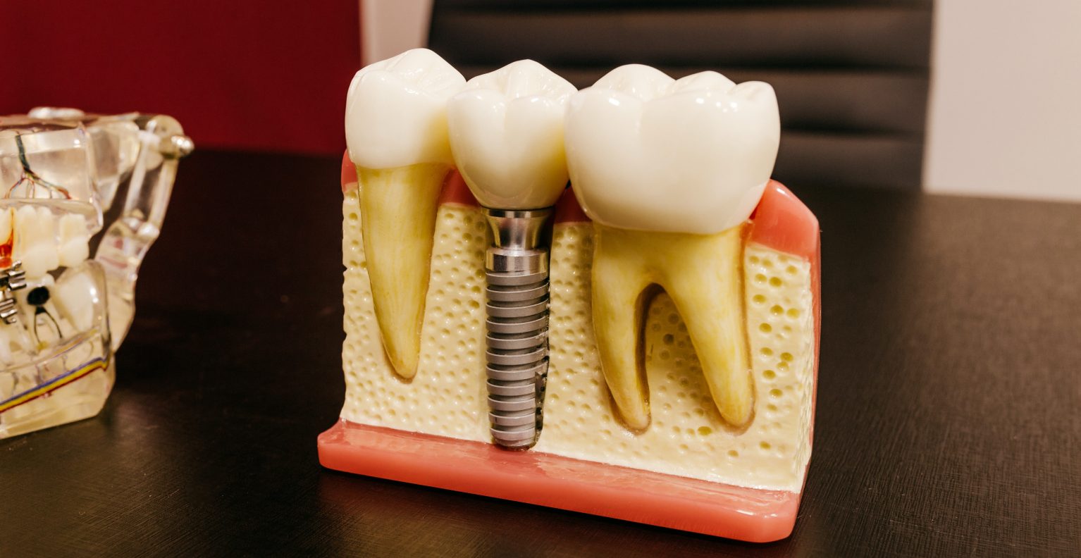 dental implants in taylor