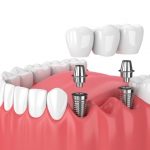 Dental Bridges Over Other Healing Processes