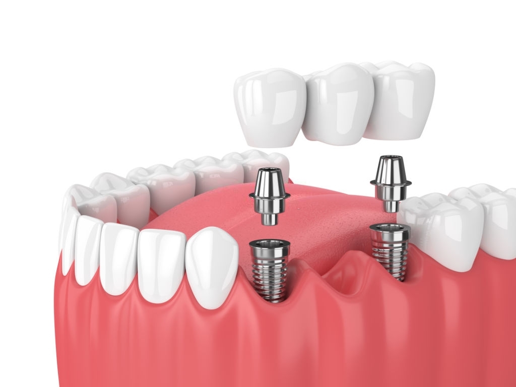 Dental Bridges Over Other Healing Processes