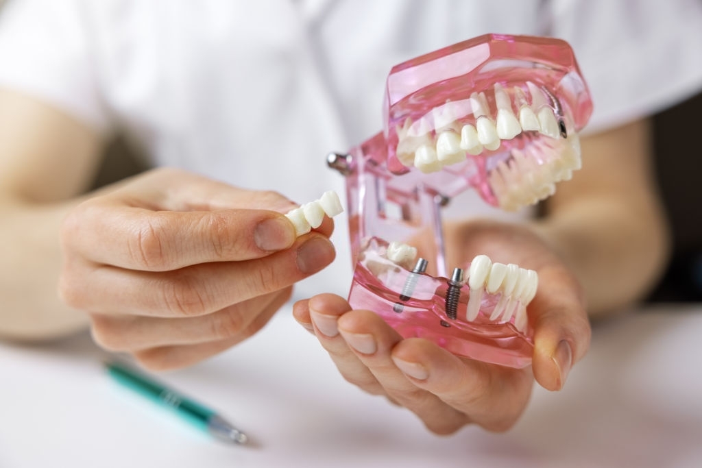 The Procedure of Getting Dental Bridges