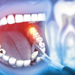 Everything You Need to Know About Tooth Extractions