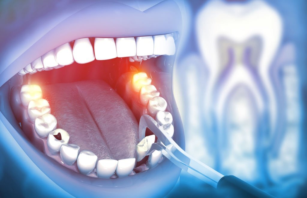 Everything You Need to Know About Tooth Extractions