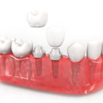 4 Signs That Your Dental Implant Is Failing