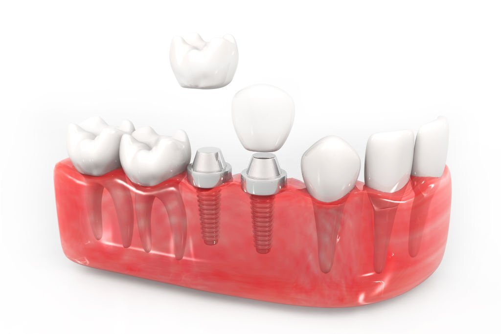 4 Signs That Your Dental Implant Is Failing