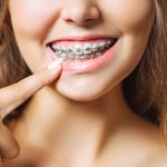 Tips To Maintaining Your Metal Braces