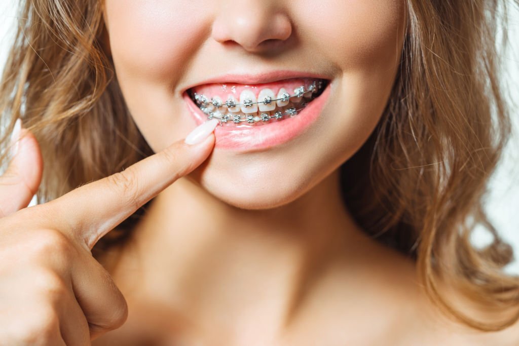 Tips To Maintaining Your Metal Braces