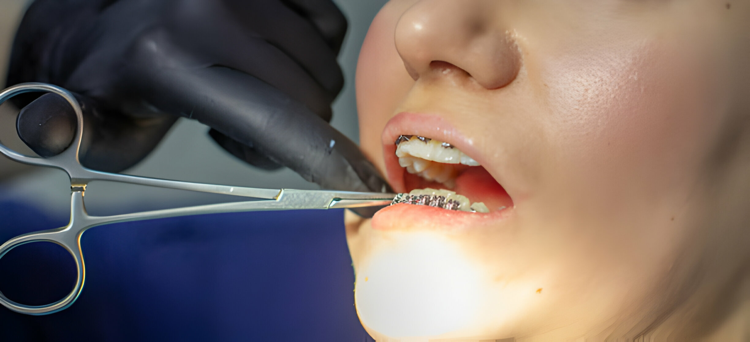 Maintaining a Healthy Smile: Essential Hygiene Tips for Invisalign Treatment_2