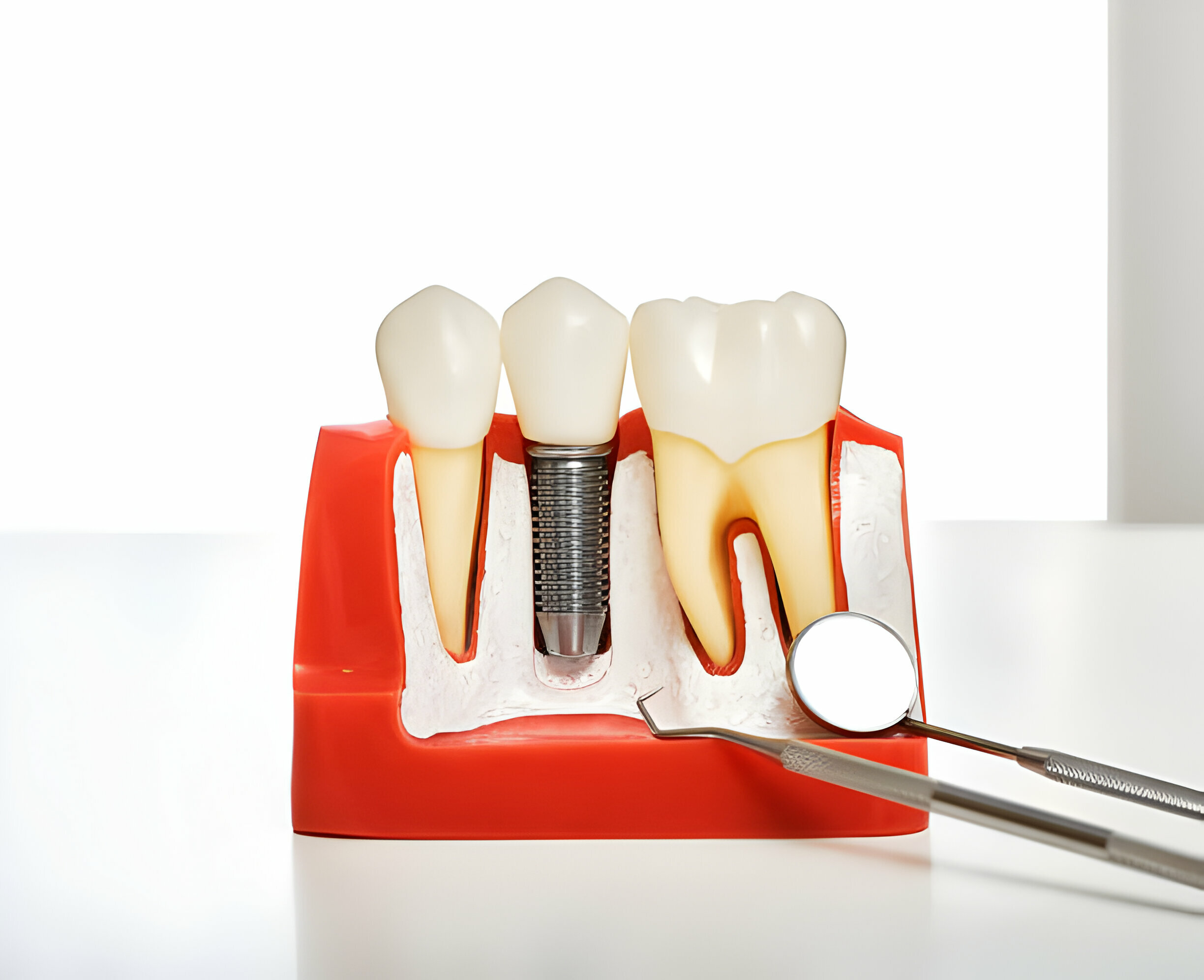 What to Expect During Dental Implants in Taylor, Texas_2