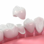 What to Expect During Dental Implants in Taylor, Texas_FI