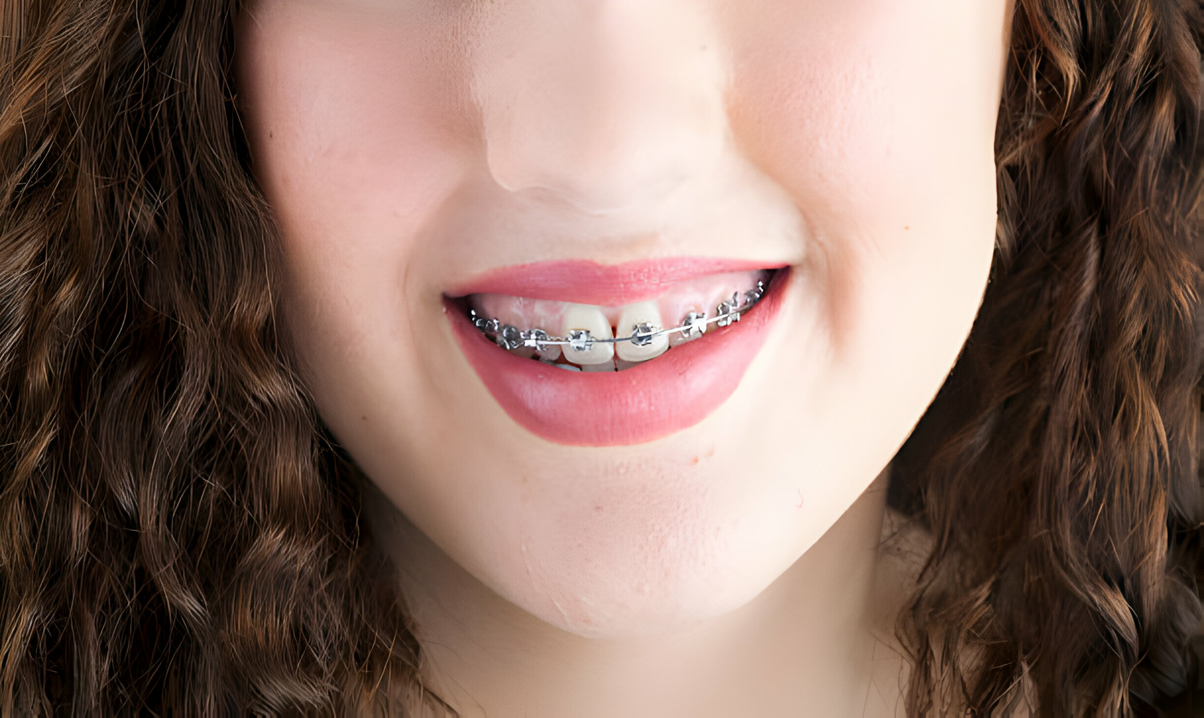 Invisalign Vs. Braces: Which Is The Right Choice For Me?_3