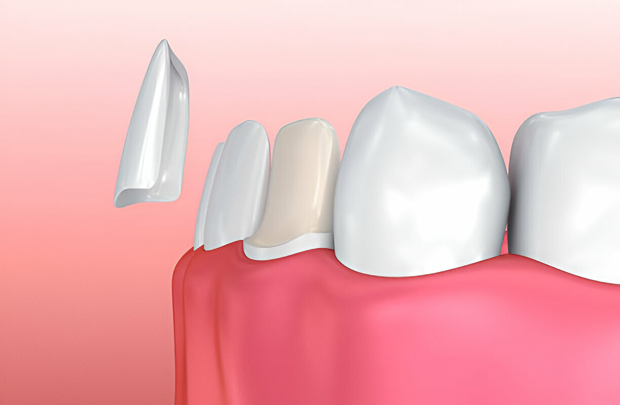 From Consultation to Smile Makeover: How Taylor Dental and Braces Offers the Best Dental Veneers in Texas_1
