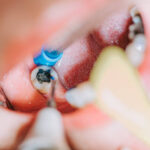 Your Guide to Recovering from A Root Canal in Taylor, TX