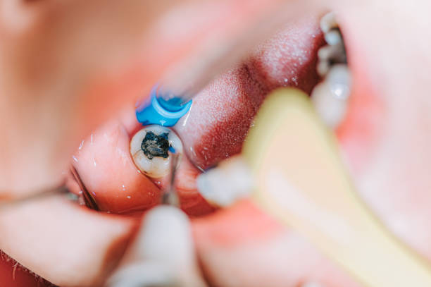 Your Guide to Recovering from A Root Canal in Taylor, TX