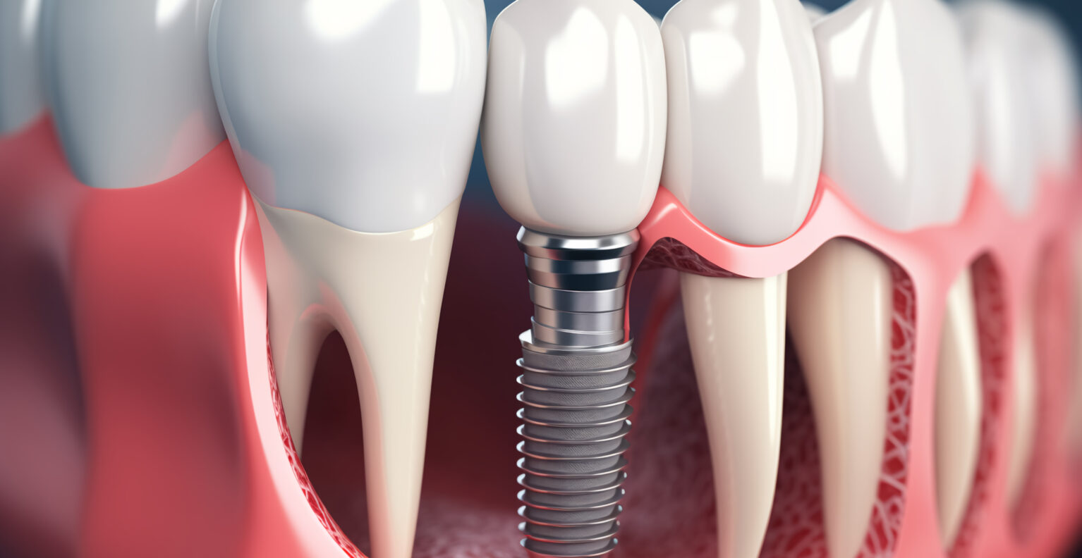Dental implants in Taylor TX replacing missing teeth permanently